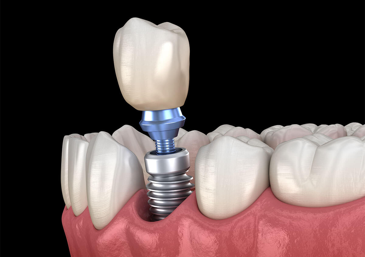 Teeth Implants South in Lakeland FL Area